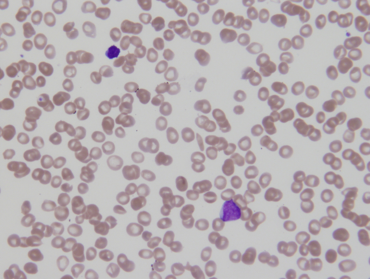 Peripheral blood: circulating blast