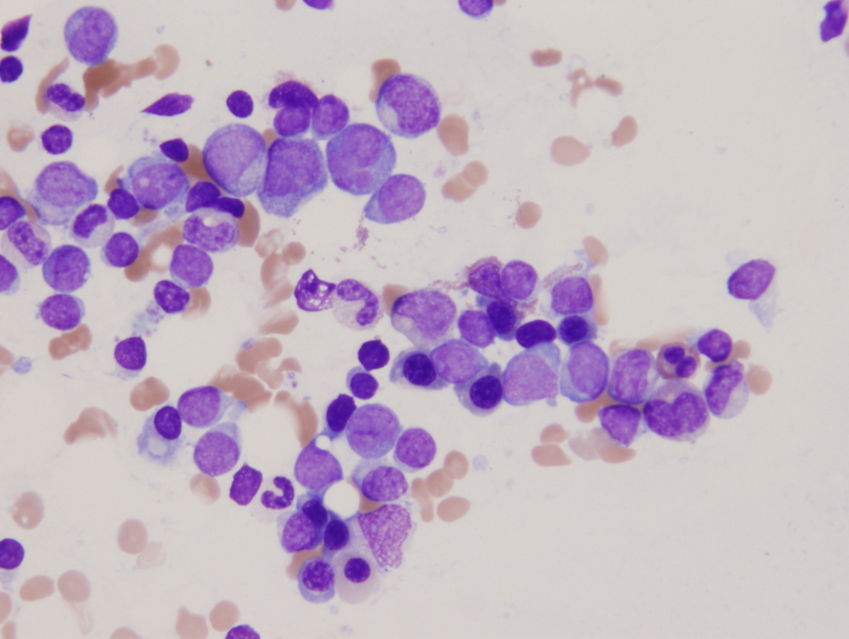 Bone marrow aspirate smear showing blasts