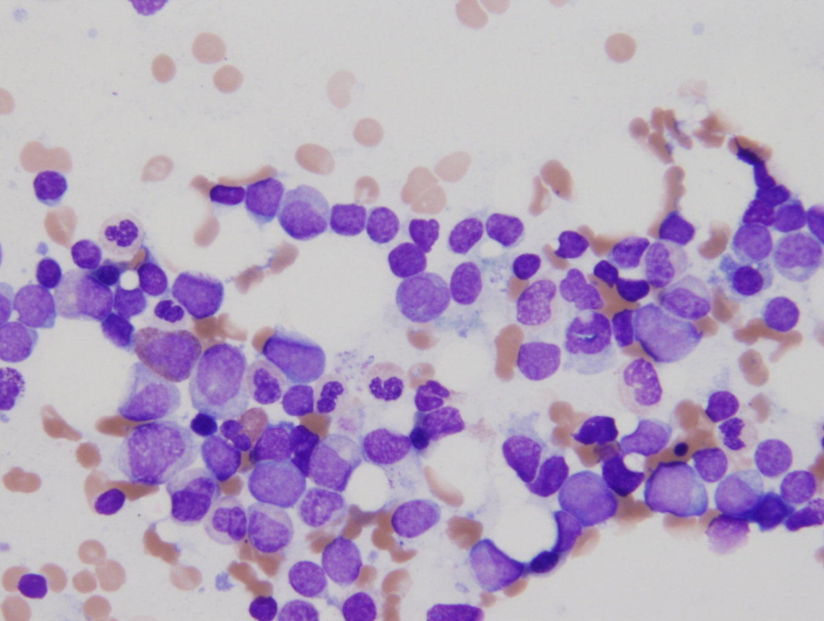 Bone marrow aspirate smear showing blasts 2