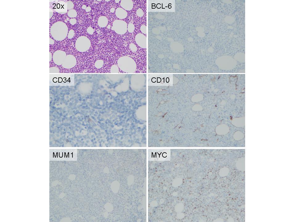 Figure 10. Immunohistochemical stains, bone marrow biopsy, 20x
