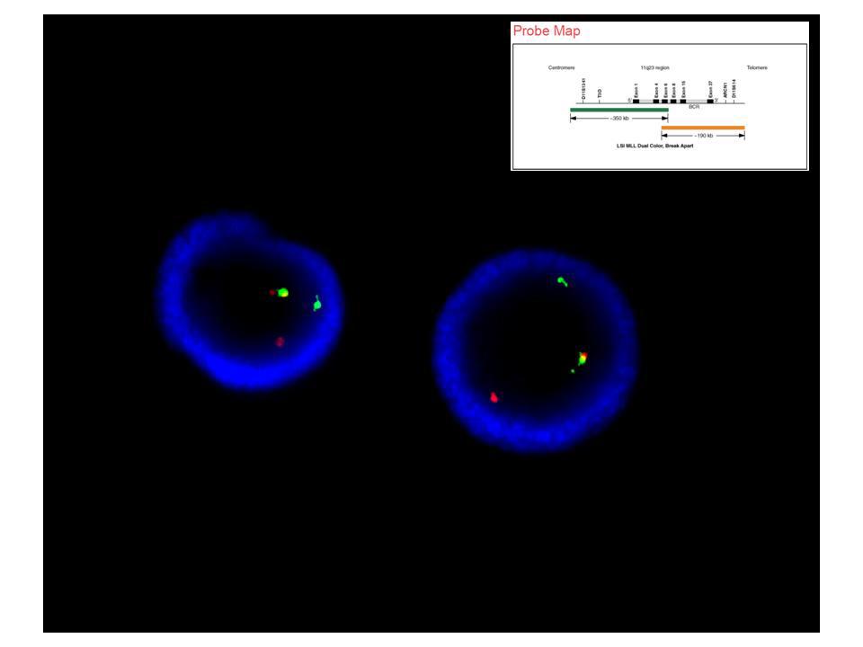 Figure 11. FISH for MLL translocation
