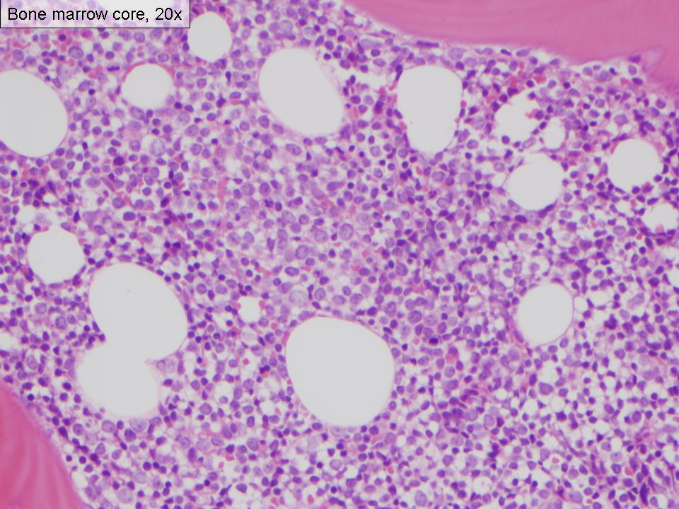 Figure 4. Bone marrow biopsy, 20x