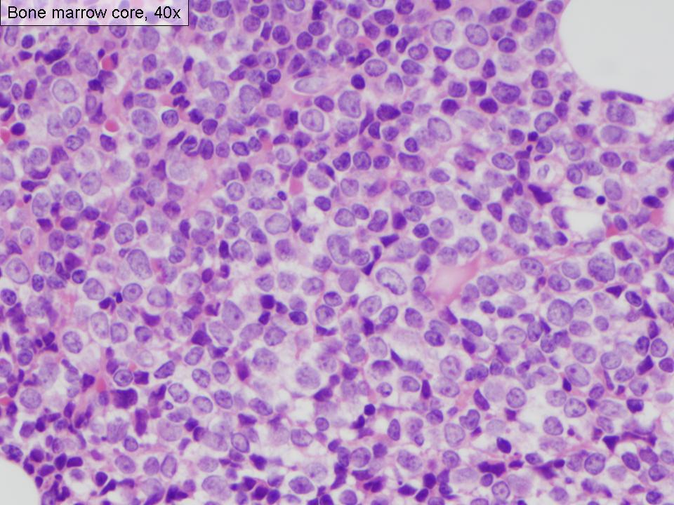 Figure 5. Bone marrow biopsy, 40x