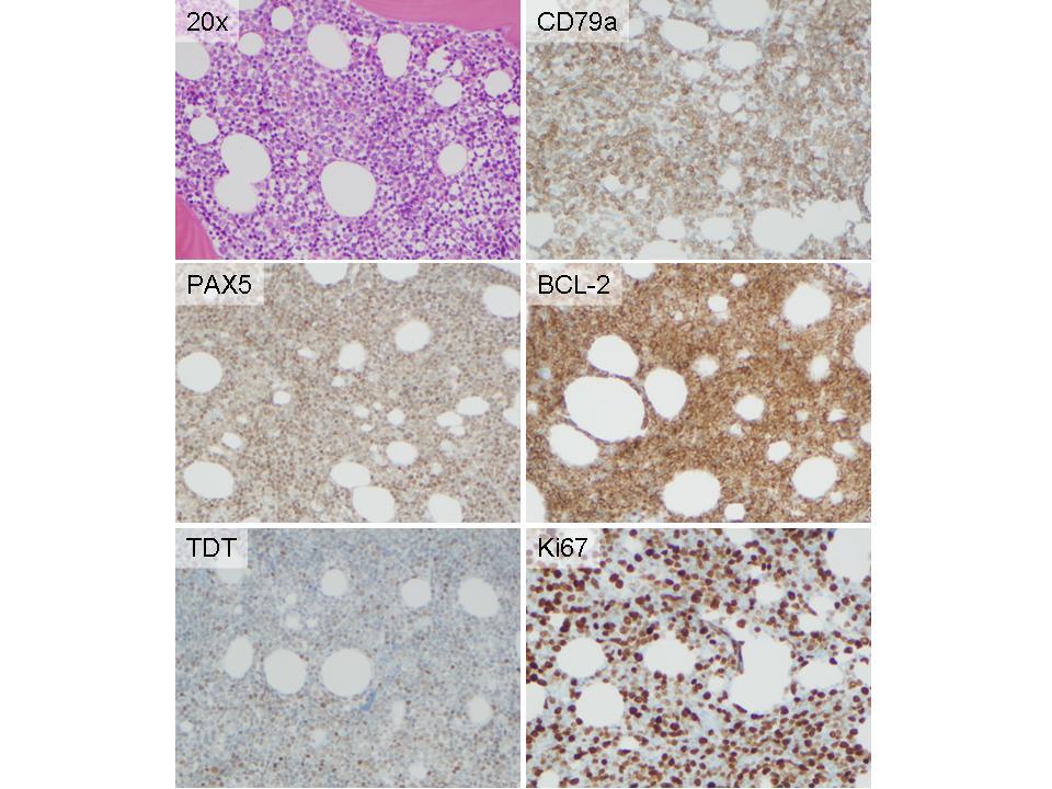 Figure 9. Immunohistochemical stains, bone marrow biopsy, 20x