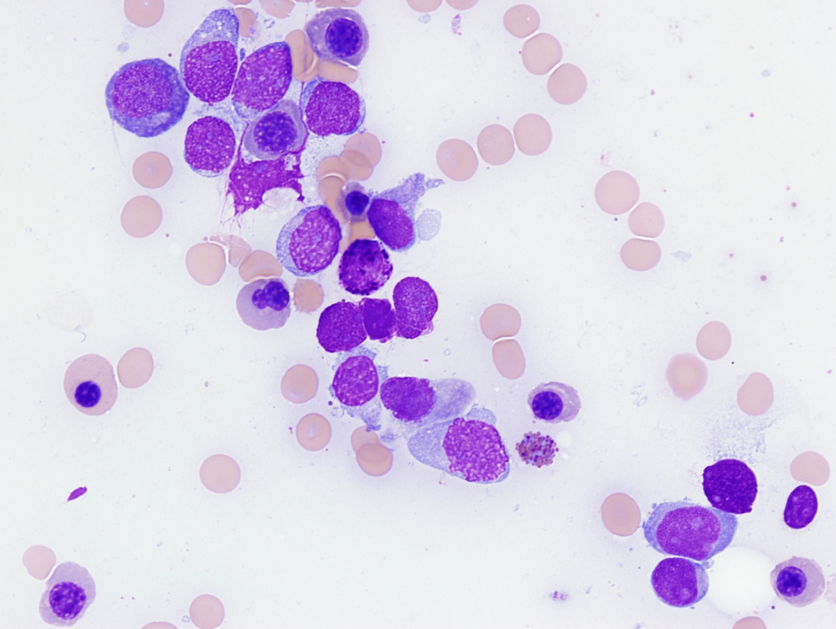 Bone marrow aspirate: AML with moncytic differentiation, basophils and dyserythroipoiesis