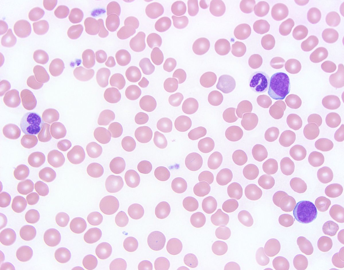 Peripheral smear: Blasts and dysplastic neutrophils.