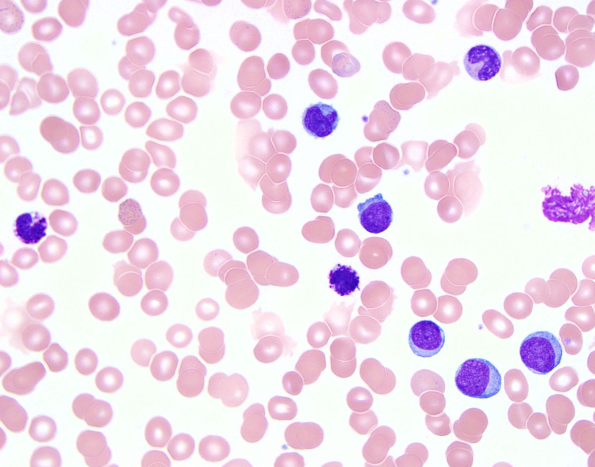 Peripheral smear: Blasts with moncytic differentiation, basophils and dysplastic neutrophilic metamyelocyte