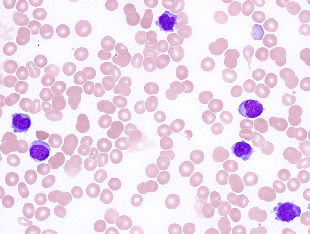 Peripheral smear: Blast with monocytic differentiation.
